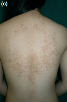 keto rash